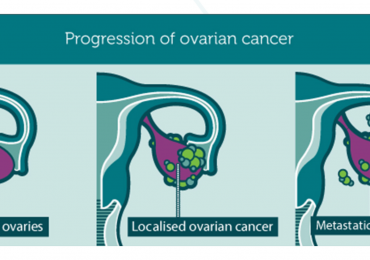 8 maggio, giornata mondiale del tumore Ovarico. La storia di Laura