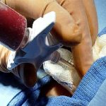 Alessandro e la leucemia: salvo grazie a un donatore anonimo di midollo
