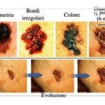 Attenti al sole! I consigli per l'esposizione e la diagnosi precoce del melanoma 1