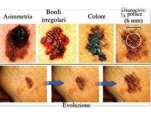 Melanoma: open frontiers for “superimmunotherapy”