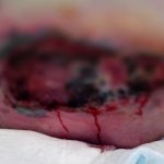 Morì per delle lesioni da pressione, assolti 5 infermieri e 2 medici 1
