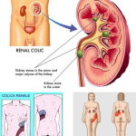 Colica renale e terapia: quale la strategia?