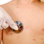 Allarme morbillo in Italia: boom di contagi e scarsa copertura vaccinale nel 2017