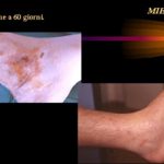 Metodo Knutson: rivoluzione o danno del Wound Care?