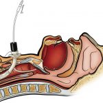 OSS e competenze infermieristiche avanzate: la legge che li abilita c’è, ma…