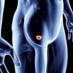 Problemi alla prostata: dieta grassa e colesterolo alto possono esserne la causa