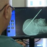 Si trapassa il cranio con una fiocina da sub, è vivo e sta bene