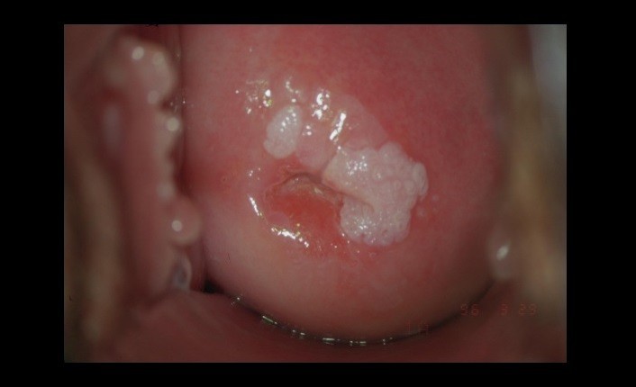 Papilloma virus e tumore gola, Virus del papiloma reacciones