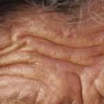 Hai molte rughe sulla fronte? Forse il tuo cuore è a rischio
