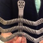 Bologna: impiantati sterno  per la prima