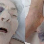 Anziana con fratture multiple in RSA: Nas di Alessandria indagano sull’accaduto