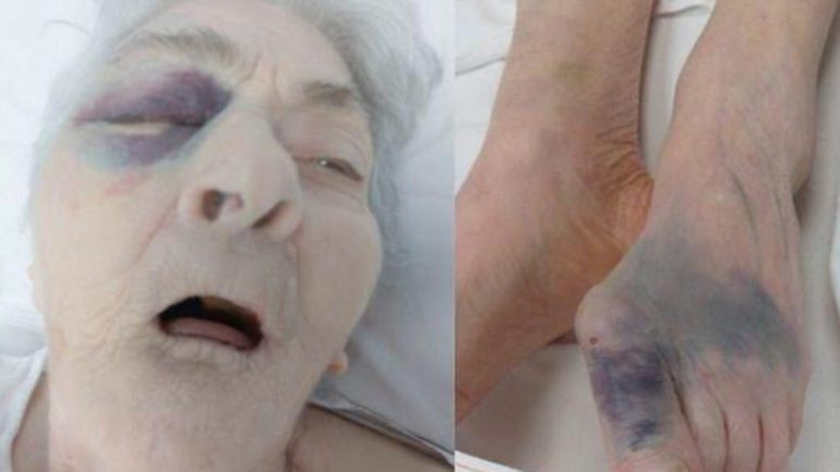 Anziana con fratture multiple in RSA: Nas di Alessandria indagano sull’accaduto