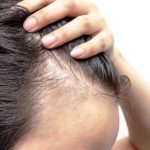 Alopecia, nel tuorlo d’uovo un possibile rimedio?