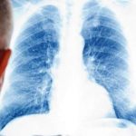 Epidemia di polmonite nel Bresciano: oltre 150 casi