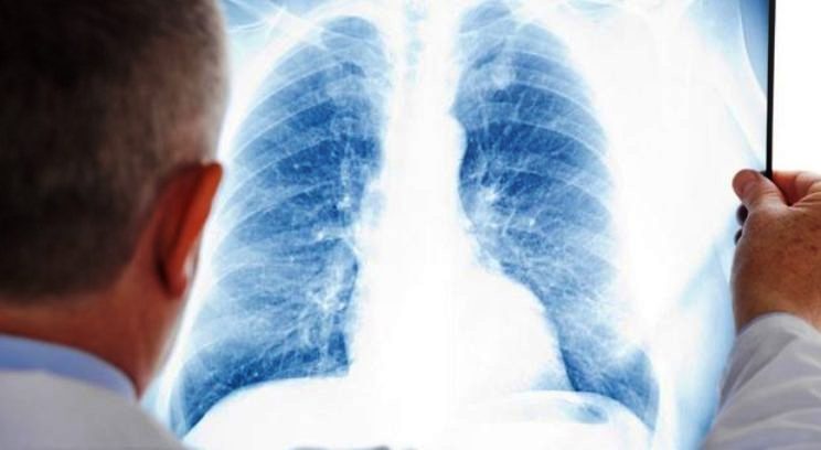 Epidemia di polmonite nel Bresciano: oltre 150 casi
