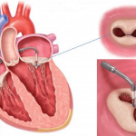 Insufficienza mitralica e il sistema MITRACLIP