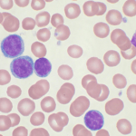 Nuova Terapia per trattamento leucemie DLBCL e LLA:  Tisagenlecleucel