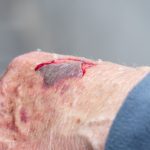 Riprogrammare le cellule per guarire le lesioni