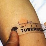 Tubercolosi, diminuisce l’incidenza in Italia