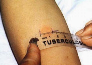 Tubercolosi, diminuisce l’incidenza in Italia