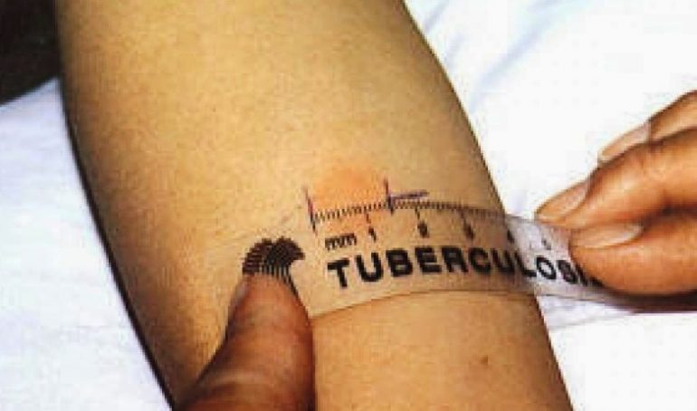 Tubercolosi, diminuisce l’incidenza in Italia