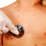 Morbillo, tutti i dati dell’emergenza in Italia