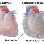 Pericardiocentesi in emergenza: rescue life 2