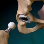 Protesi di femore, anca, ginocchio e spalla: il Lazio ha gli ospedali migliori