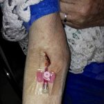 Dimessa dal PS con agocannula nel braccio: i parenti gridano allo scandalo. Avviata indagine interna