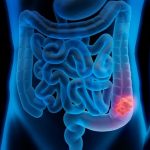 Lazio, al via la campagna per la prevenzione del tumore al colon retto