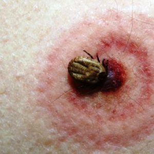 Malattia di Lyme: se la conosci, la curi 1