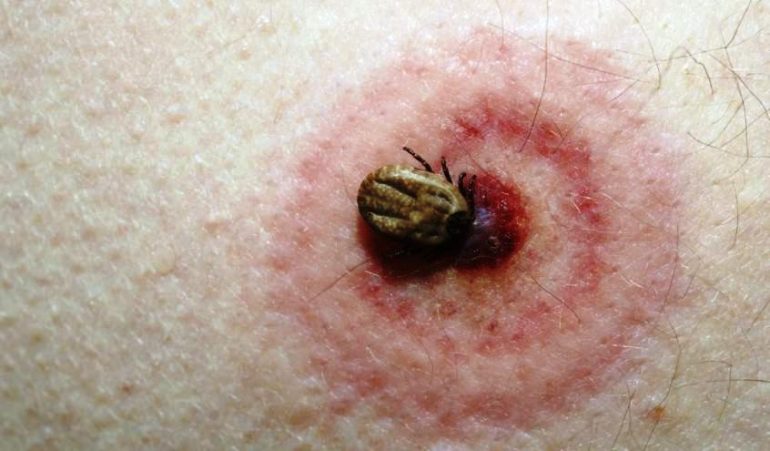 Malattia di Lyme: se la conosci, la curi 1