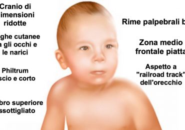 Ogni anno in Italia nascono 25.000 bimbi affetti da sindrome alcolica fetale