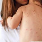 Otto casi di morbillo in pediatria: figlia di genitori NoVax probabile “paziente zero”