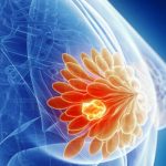 Ricerca, provata l’efficacia di un antibiotico per l’acne nella terapia per il tumore al seno