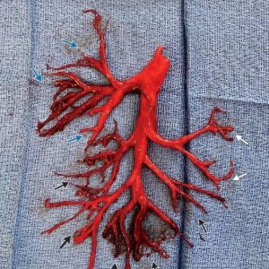 Emottisi con espettorazione di calco dell’albero bronchiale destro: un caso clinico