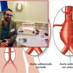 EnduraGel: l’idrogel in grado di prevenire la rottura di un aneurisma