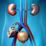 Allo studio il rene bionico: addio all’emodialisi?