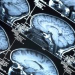 Parkinson, promettono bene le trasfusioni con un mix di mille proteine
