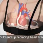 Cuore artificiale senza fili: nuove prospettive per la cardiochirurgia