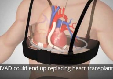 Cuore artificiale senza fili: nuove prospettive per la cardiochirurgia