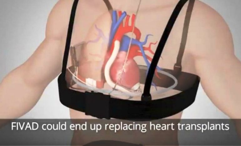 Cuore artificiale senza fili: nuove prospettive per la cardiochirurgia