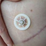 DiaPort: debutta al San Raffaele il dispositivo per l’infusione di insulina intraperitoneale 1