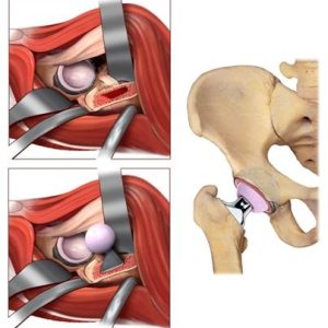 La via anteriore mini-invasiva nella chirurgia protesi d'anca 1