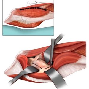 La via anteriore mini-invasiva nella chirurgia protesi d'anca