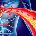 Malattie cardiovascolari, in arrivo i nuovi scudi salva-cuore
