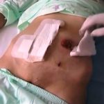 Napoli, da un’idea di quattro infermieri nasce l’ambulatorio gratuito per pazienti stomizzati