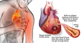 Pillole di Educazione Sanitaria: Prevenzione e complicanze delle malattie cardiovascolari 1