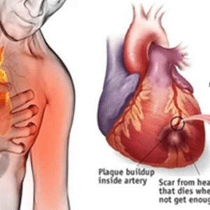 Pillole di Educazione Sanitaria: Prevenzione e complicanze delle malattie cardiovascolari 1