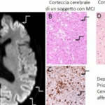 Malattia di Creutzfeldt-Jakob: due nuovi test per identificarla e predirla